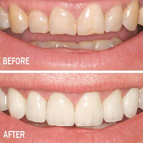 Smile design