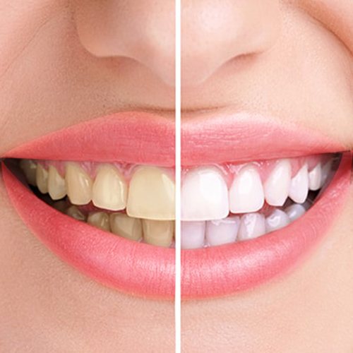 Teeth whitening