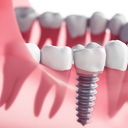 Implant placement plan