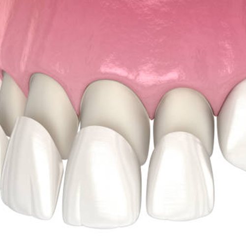 Porcelain veneers