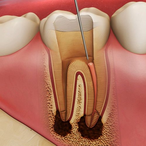 CBCT and 3D planning